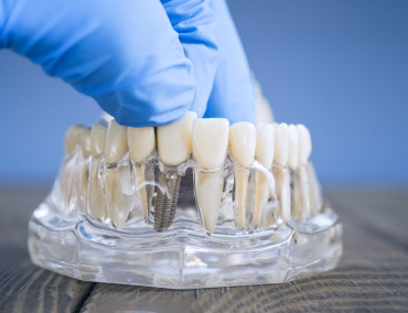 Implant dentaire Tunisie
